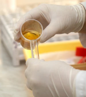 NEFROLOGIA » Teste de urina pode prever insuficiência renal grave