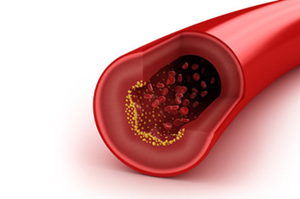 LDL-colesterol e os efeitos da terapia com estatinas: catarata pode ser um dos efeitos adversos principais, segundo meta-análise publicada pelo JACC