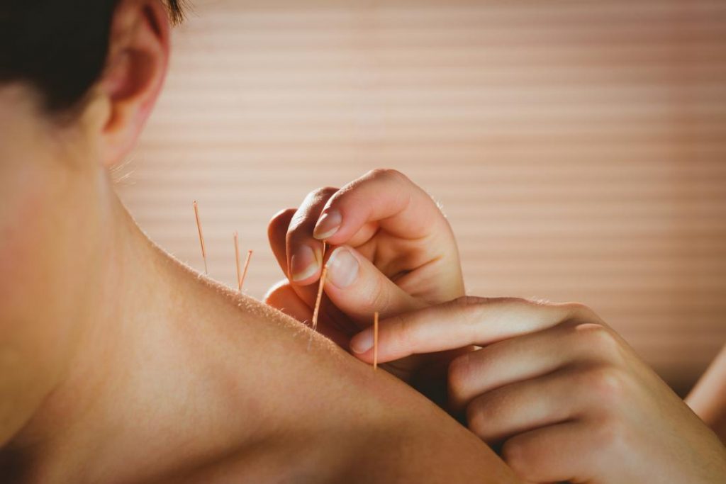 woman-receiving-acupuncture-on-her-shoulder