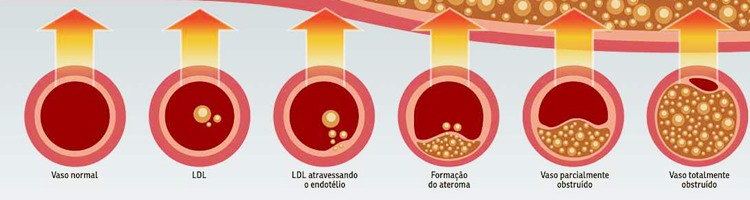 Mau colesterol oferece riscos à saúde mesmo a um adulto saudável