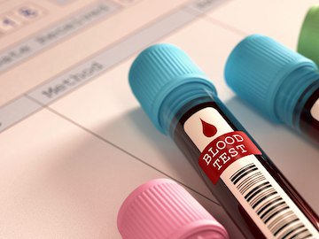 Um exame de sangue pode ser suficiente para diagnosticar com precisão o diabetes tipo 2