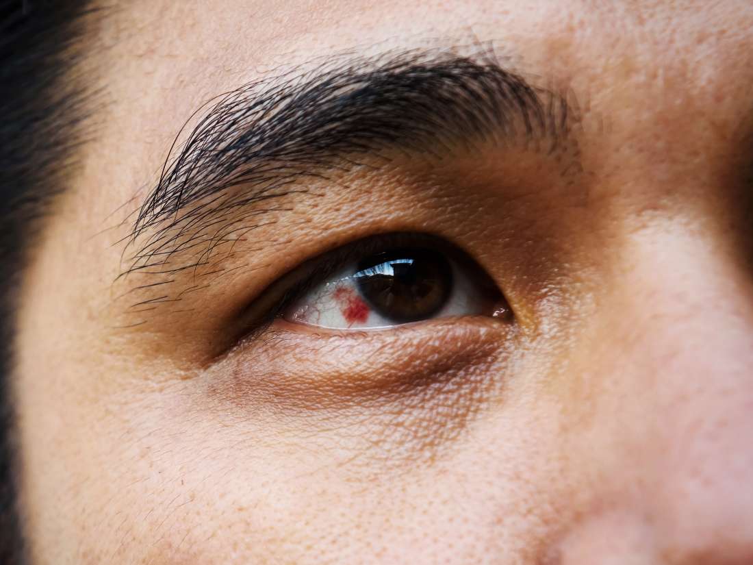 O Que Causa uma Mancha Vermelha no Olho?