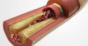 108.Hipertrigliceridemia Muito Grave Associada ao Diabetes Revela Lacunas nos Controles