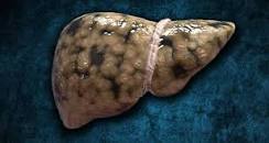 Fígado Gorduroso Afeta Negativamente a Função das Células Beta