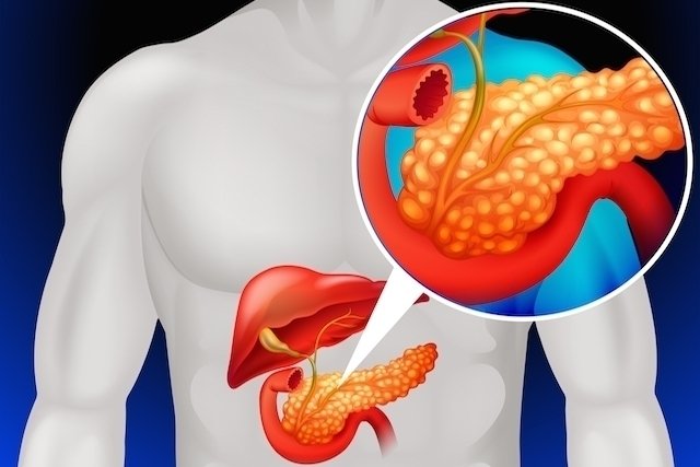 A Gordura no Pâncreas Pode Proteger Contra o Diabetes?