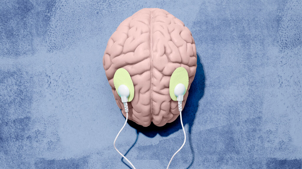 A Estimulação Cerebral Pode Tratar a ” Névoa Cerebral” do COVID Longo?
